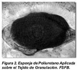Esponja de Polieuretano en la Cavidad Abdominal