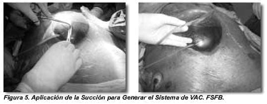 Aplicación de la Succión para Generar el Sistema de VAC