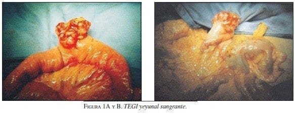 TEGI Yeyunal Sangrante TEGI Yeyunal Sangrante
