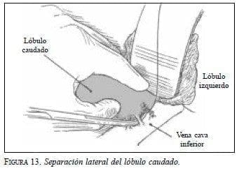 Separación lateral del Lóbulo Caudado Separación lateral del Lóbulo Caudado