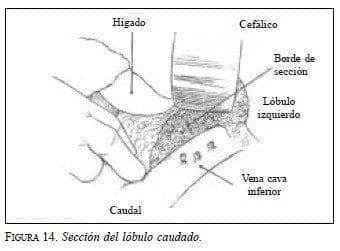 Sección del Lóbulo Caudado Sección del Lóbulo Caudado