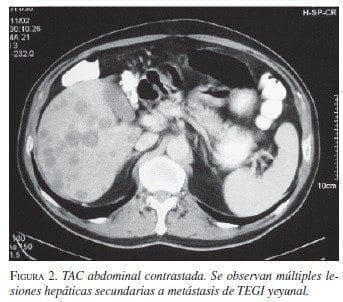 TAC Abdominal Contrastada TAC Abdominal Contrastada