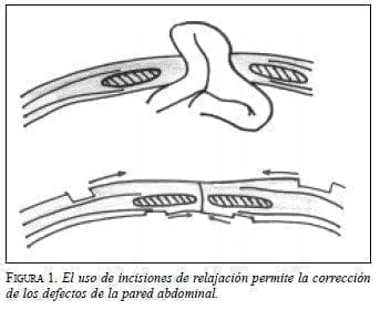 Corrección de los Defectos de la Pared Abdominal Corrección de los Defectos de la Pared Abdominal