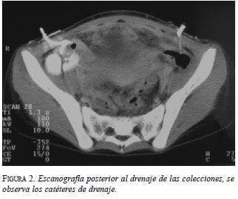 Escanografía Posterior al Drenaje de las Colecciones