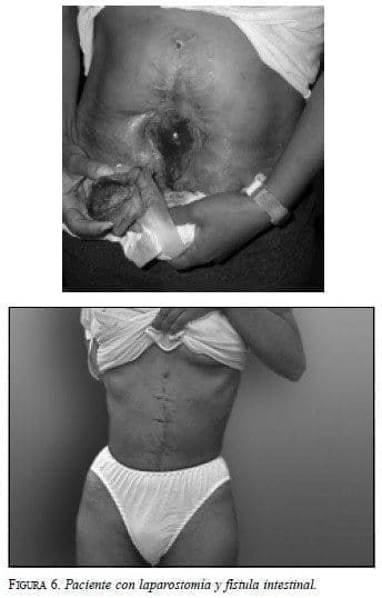 Paciente con Laparostomía y Fístula Intestinal