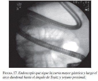 Endoscopio que sigue la curva mayor Gástrica