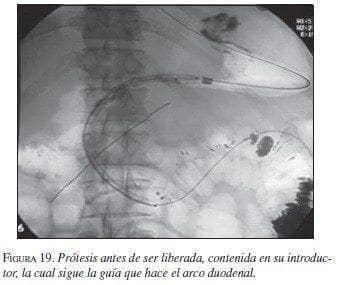 Prótesis antes de ser liberada