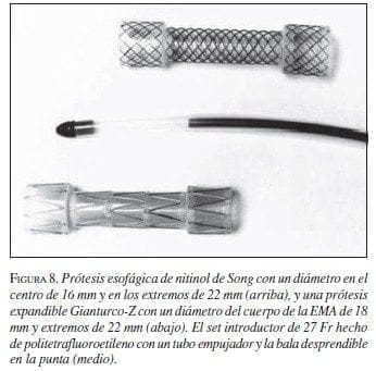 Prótesis Esofágica de Nitinol de Song Prótesis Esofágica de Nitinol de Song