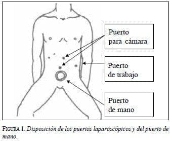 Disposición de los Puertos Laparoscópicos y del puerto de Mano