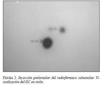 Inyección periareolar del radiofármaco subareolar