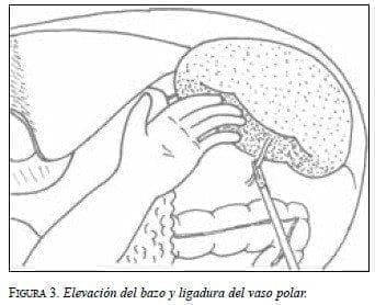 Elevación del Bazo y Ligadura del Vaso Polar