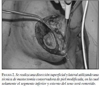 Disección Superficial y Lateral utilizando una Técnica de Mastectomía Disección Superficial y Lateral utilizando una Técnica de Mastectomía