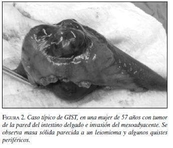Caso típico de GIST