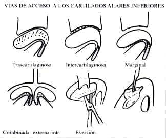 Vías endonasales