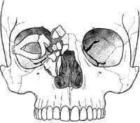 Fractura naso órbito etmoidal