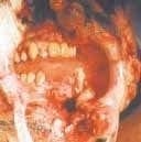 Fractura mandibular difícil de intubar