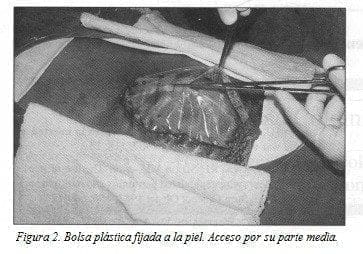 Bolsa Plástica fijada a la pie