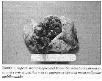 Aspecto Macroscópico del Tumor