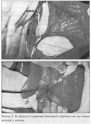 Segmento Intestinal a injertar con sus ramas Arterial y Venosa