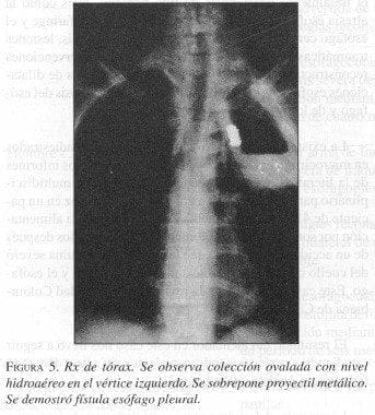 Rx de Tórax