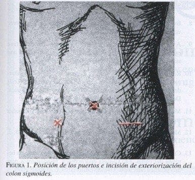 Posición de los puertos e incisión de exteriorización del colon sigmoides Posición de los puertos e incisión de Exteriorización del Colon Sigmoides