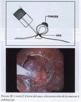 Cierre del Asa y Electrosección de la Mucosa y Submucosa