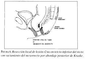Resección local de Lesión t2 no en tercio inferior del recto
