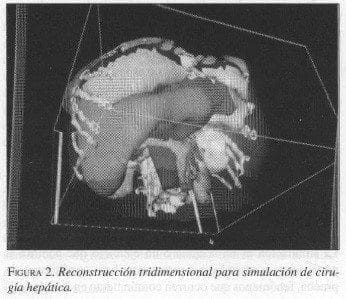 Reconstrucción Tridimensional para simulación de Cirugía Hepática Reconstrucción Tridimensional para simulación de Cirugía Hepática