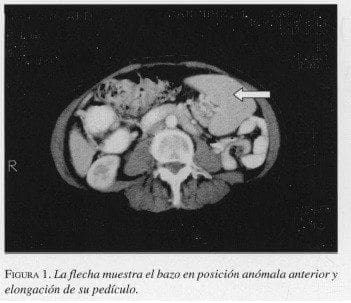 Bazo en posición Anómala anterior y elongación de su Pedículo
