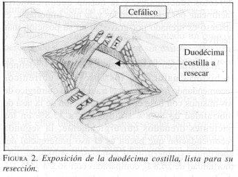 Exposición de la Duodécima costilla, lista para su resección