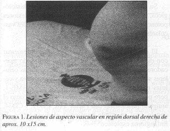 Lesiones de aspecto Vascular en región dorsal derecha