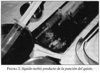 Líquido Turbio producto de la Punción del Quiste