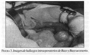 Imagen de Hallazgos Intraoperatorios de Bazo y Bazo Accesorio