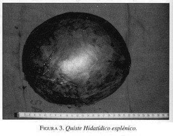 Quiste Hidatídico Esplénico
