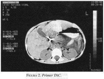 Seudotumor Inflamatorio de Hígado, Primer TAC