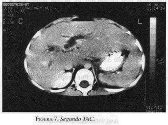 Seudotumor Inflamatorio de Hígado, Segundo TAC