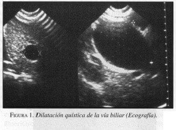 Dilatación quística de la vía biliar (Ecografía)
