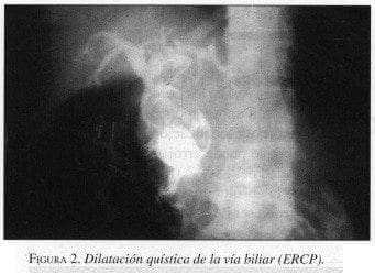 Dilatación Quística de la Vía Biliar (ERC?)