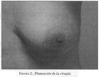Mastectomía, Planeación de la cirugía