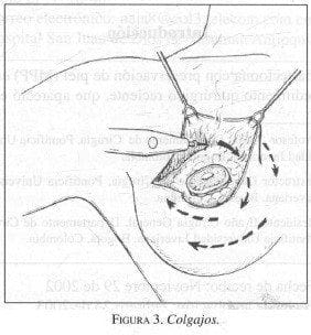 Mastectomía, Colgajos