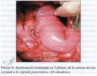Anastomosis Terminada en 2 planos