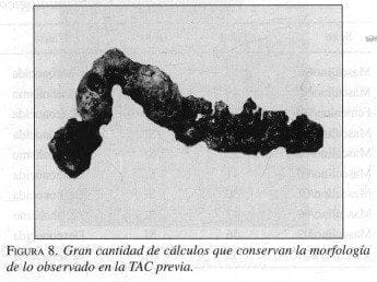 Gran cantidad de cálculos, Pancreatitis Crónica