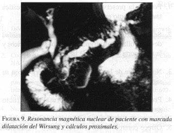 Dilatación del Wirsung y Cálculos proximales