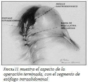 Aspecto de la Operación Terminada