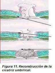Reconstrucción de la Cicatriz Umbilical