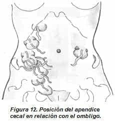 Posición del Apendice Cecal en relación con el Ombligo Posición del Apendice Cecal en relación con el Ombligo