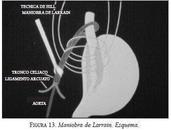 Maniobra de Larrain. Esquema