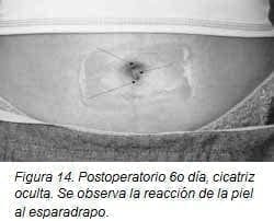 Postoperatorio 6o día, Cicatriz Oculta Postoperatorio 6o día, Cicatriz Oculta