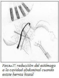 Reducción del Estómago a la cavidad Abdominal