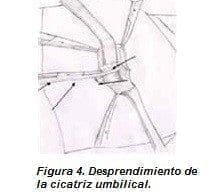Desprendimiento de la Cicatriz Umbilical